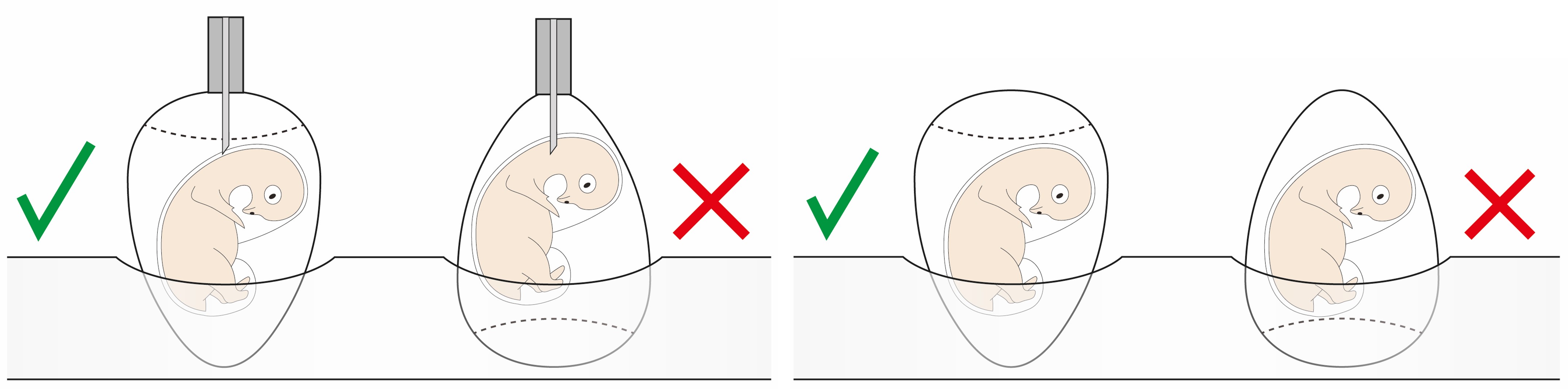 Prinzen point down setting (drawing)